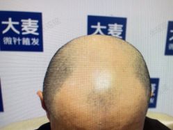 -大麦微针植发丨全国连锁