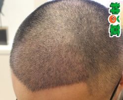 -大麦微针植发丨全国连锁