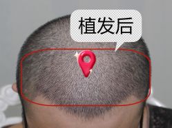 -大麦微针植发全国连锁