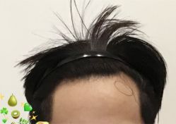 -大麦微针植发全国连锁