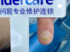 -Andrew指甲专科灰指甲·甲沟炎矫正·3D步态矫形鞋垫定制(浦三路店)