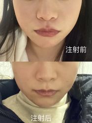 体验前-恒博天姿医疗美容