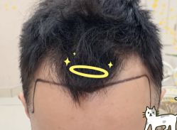 -大麦微针植发全国连锁