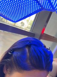 -碧莲盛·不剃发植发