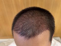 -雍禾植发