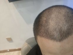-碧莲盛·不剃发植发