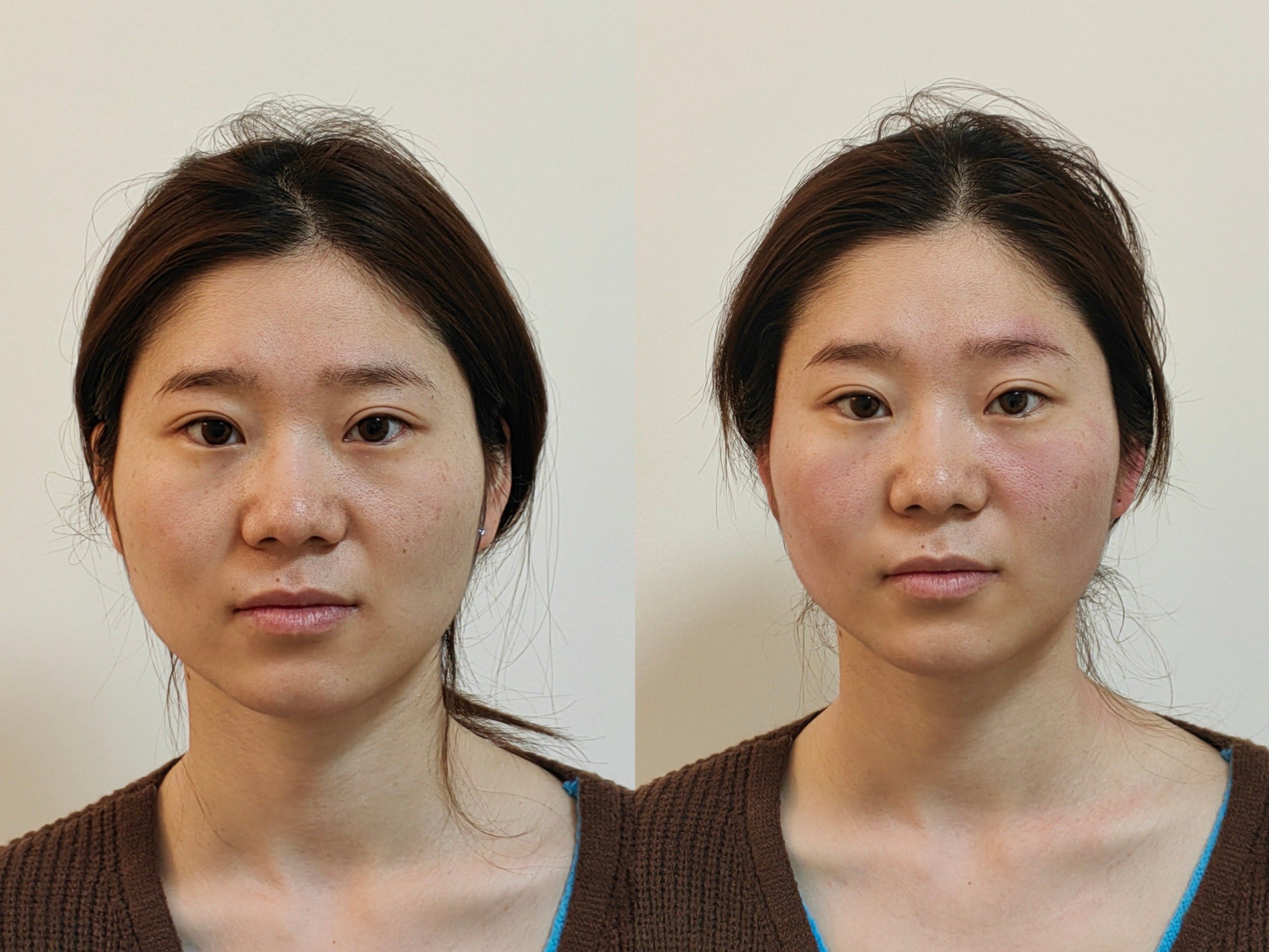 第一次做提拉抗衰被惊艳到啦