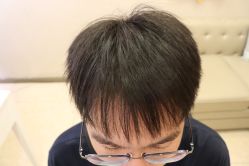 -大麦微针植发丨全国连锁