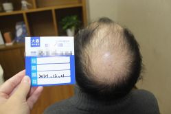 -大麦微针植发全国连锁