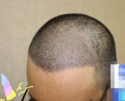 -大麦微针植发丨全国连锁