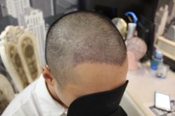 -大麦微针植发丨全国连锁