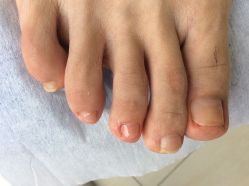 -德哥灰指甲脚气甲沟炎跖疣护理