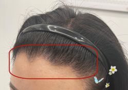 -大麦微针植发全国连锁