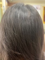 点击看大图 -碧莲盛·不剃发植发