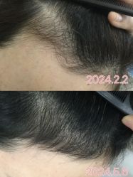 -菩叶脱发白发中心