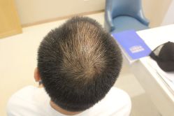 点击看大图 -大麦微针植发丨全国连锁