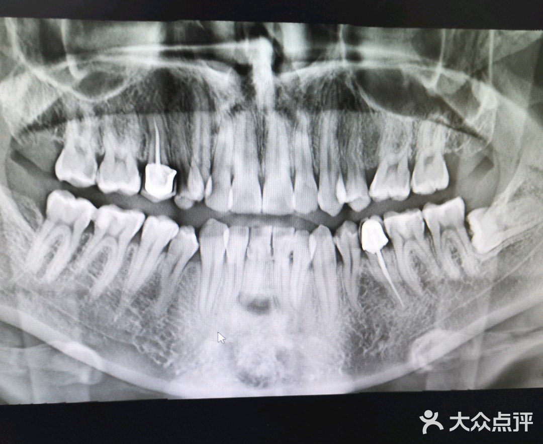 牙套日记|时代天使隐形矫正双模冠军