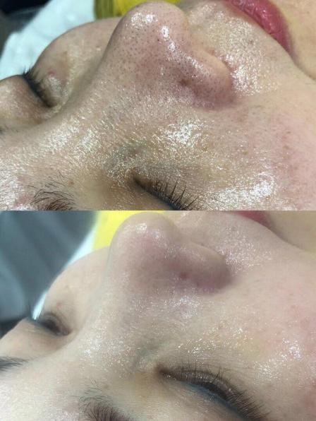 童颜美学-"【项目】小气泡 面部紧致 无针水光今天."-大众点评移动版