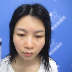 -碧莲盛·不剃发植发