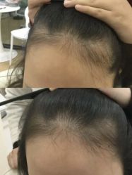 -菩叶脱发白发中心