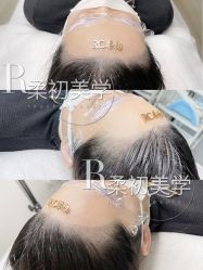 -RC半永久纹眉纹发际线