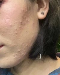 -悟空祛痘·诺奖技术专业店