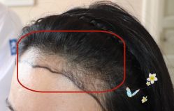 -大麦微针植发全国连锁