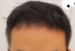 -大麦微针植发全国连锁