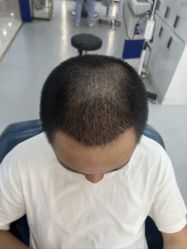 -大麦微针植发全国连锁