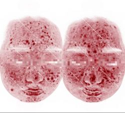 -靓芙泉专研痘痘肌