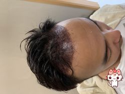 -大麦微针植发丨全国连锁