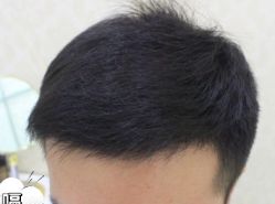 -大麦微针植发丨全国连锁