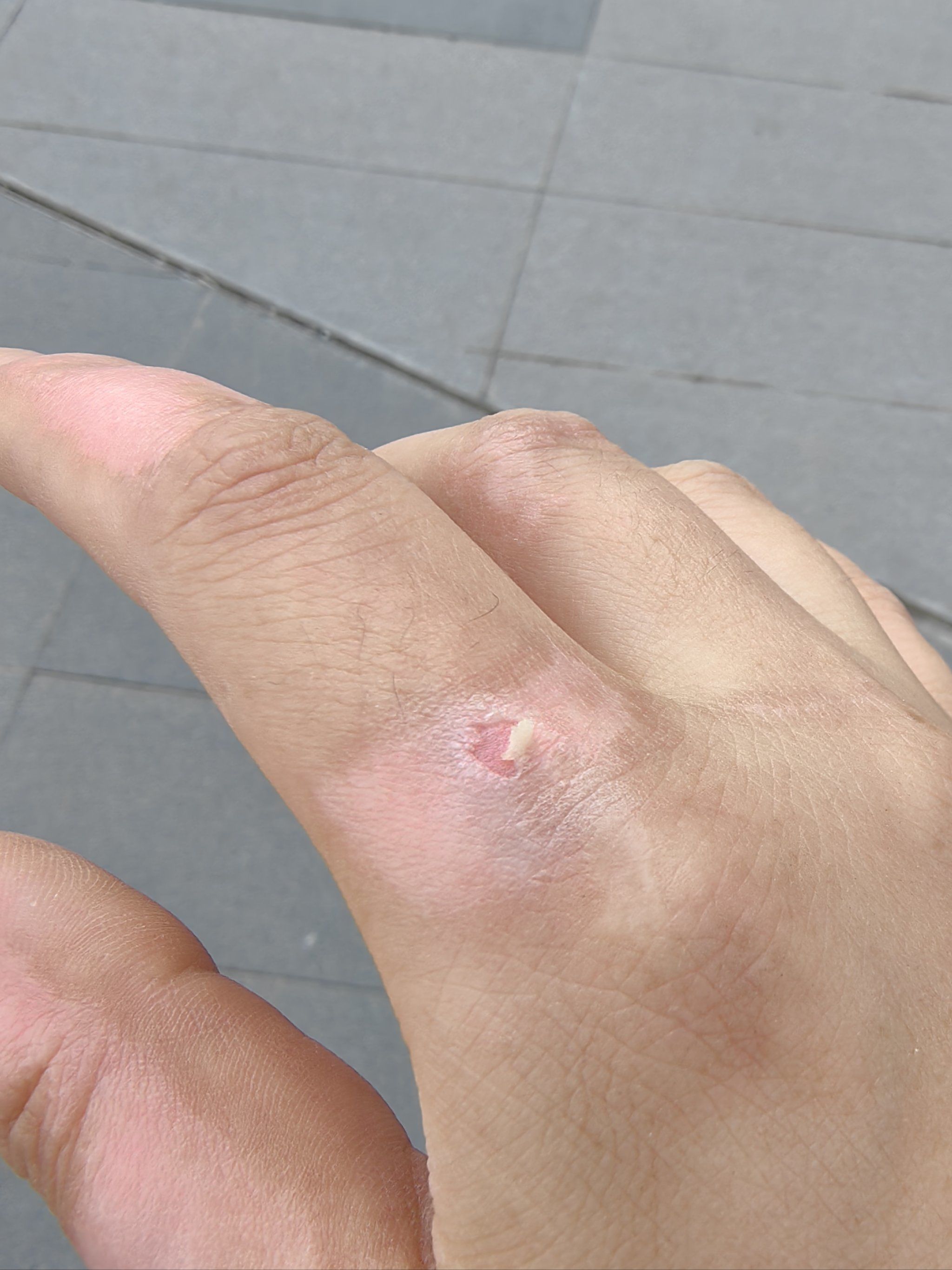 好不容易长起来的皮又碰破了🥲