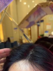 -碧莲盛·不剃发植发