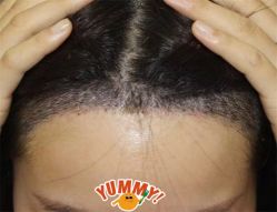 -大麦微针植发全国连锁