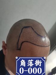点击看大图 -熙朵美学植发连锁