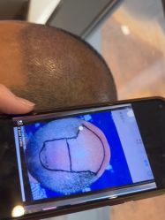 -碧莲盛·不剃发植发