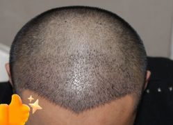 -大麦微针植发丨全国连锁