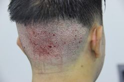 点击看大图 -大麦微针植发丨全国连锁