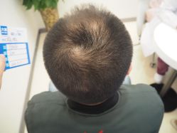 -大麦微针植发丨全国连锁