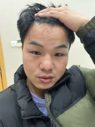 -大麦微针植发丨全国连锁