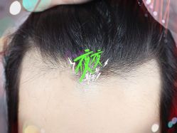-大麦微针植发全国连锁
