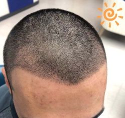 -大麦微针植发丨全国连锁