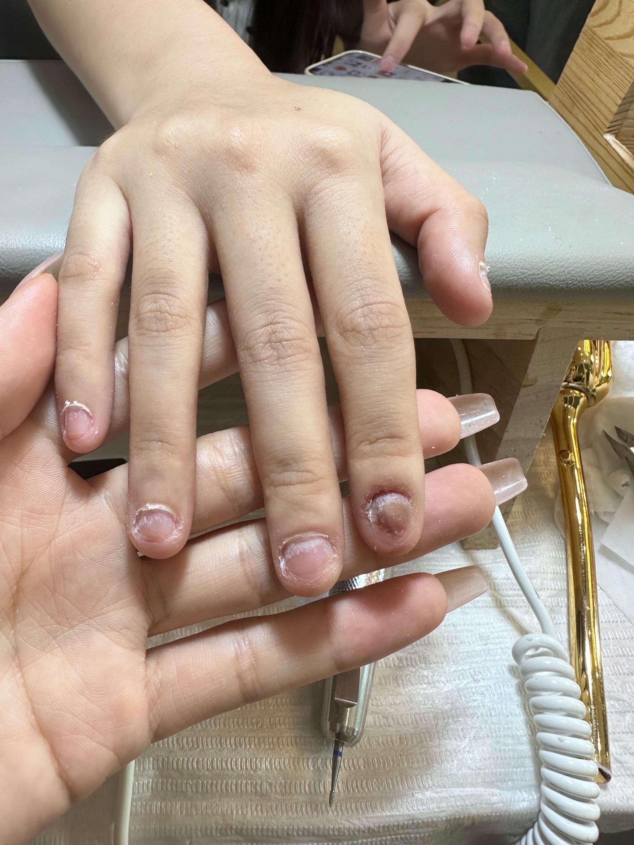 啃咬甲做完前后对比