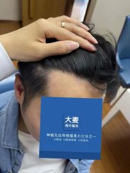 -大麦微针植发全国连锁