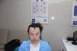 -大麦微针植发全国连锁