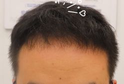 -大麦微针植发全国连锁