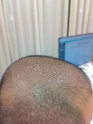 点击看大图 体验后-碧莲盛·不剃发植发