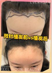 -大麦微针植发全国连锁