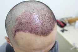 点击看大图 -大麦微针植发丨全国连锁